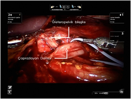 Operasyon esnasındaki  çaprazlayan damarın görüntüsü (mavi ok)