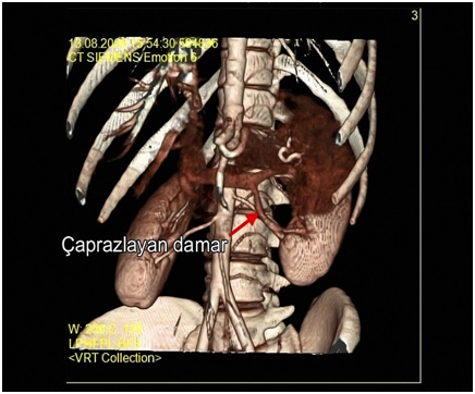 Bilgisayarlı tomografide sol böbrekte üreteropelvik bileşkeyi çaprazlayan damarın görüntüsü (kırmızı ok)