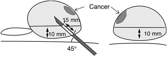 Prostat Biyopsisi