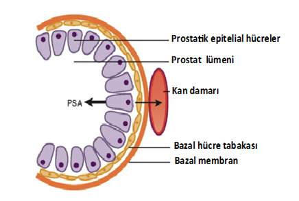 tratamentul adenomului prostatita benign prostatic hyperplasia pathology outlines