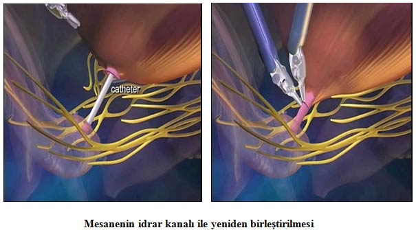 Mesanenin idrar kanalı ile yeniden birleştirilmesi